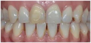 Crown rehabilitation: before treatment