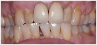 Crown rehabilitation: after treatment