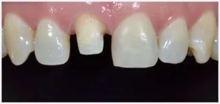 Crowns · case 2: before treatment