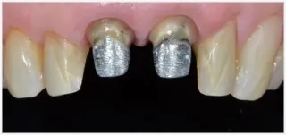 Crowns · case 2: after treatment