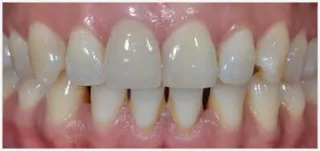 Crowns · case 3: before treatment
