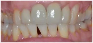Crowns · case 3: after treatment