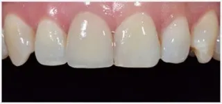 Crowns · case 4: before treatment