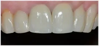 Crowns · case 4: after treatment