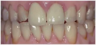 Implants · case 1: before treatment