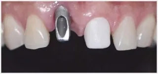 Implants · case 1: after treatment