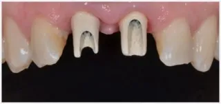 Implants · case 2: before treatment