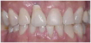 Implants · case 2: after treatment