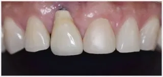 Implants · case 3: after treatment