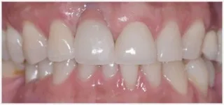 Implants · case 4: after treatment