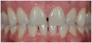 Composite fillings · case 1: before treatment