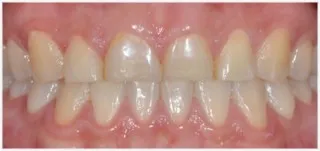 Composite fillings · case 1: after treatment
