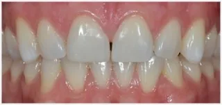 Composite fillings · case 2: before treatment