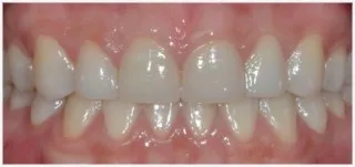 Composite fillings · case 2: after treatment