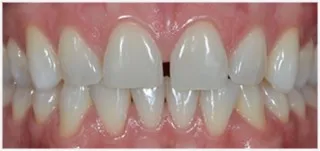 Composite fillings · case 3: before treatment