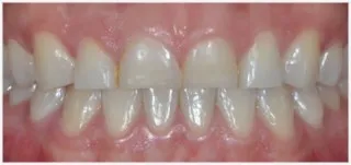 Composite fillings · case 3: after treatment