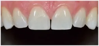 Composite fillings · case 4: before treatment
