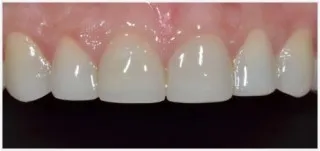Composite fillings · case 4: after treatment