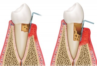 https://www.elitedental.cl/home/wp-content/uploads/2015/11/periodoncia-320x219.jpg