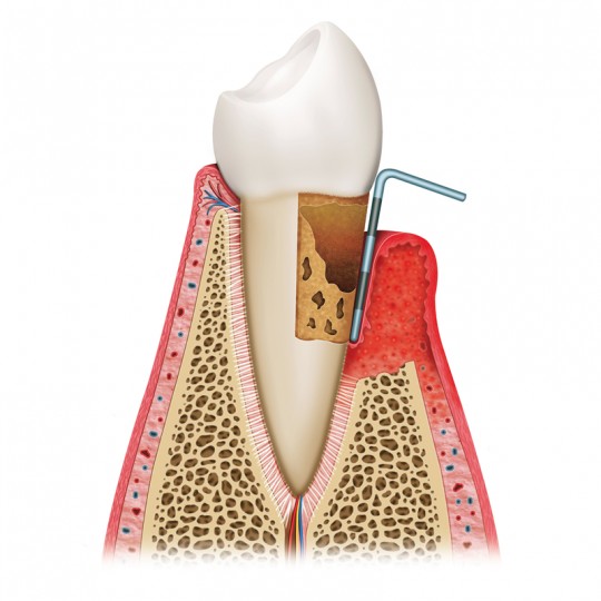 https://www.elitedental.cl/home/wp-content/uploads/2016/05/periodoncia03-540x540.jpg